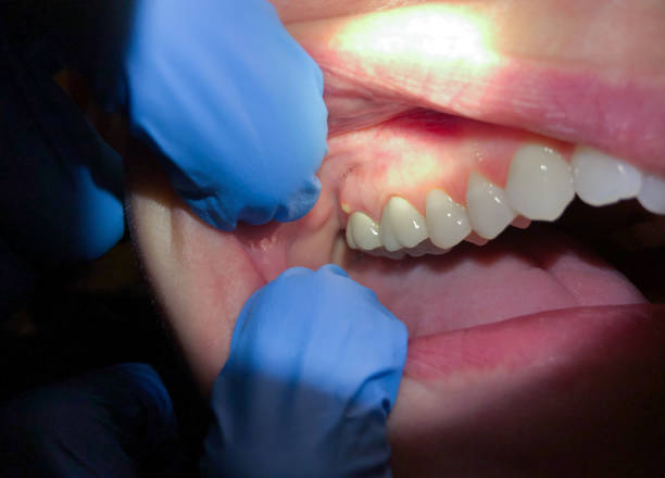 Best Broken or Cracked Tooth Emergency Dentist in Lakemont, PA
